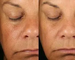 Del pulso de luz al resultado: entender la IPL con criterio clínico